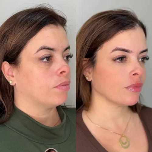 Preenchimento acido hialuronico sorocaba campolim