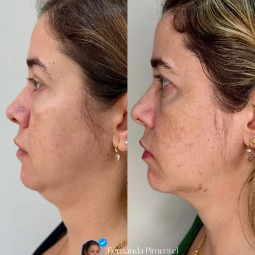 foto ultraformer mpt em o sorocaba no campolim