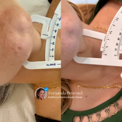 foto ultraformer mpt em o sorocaba no campolim